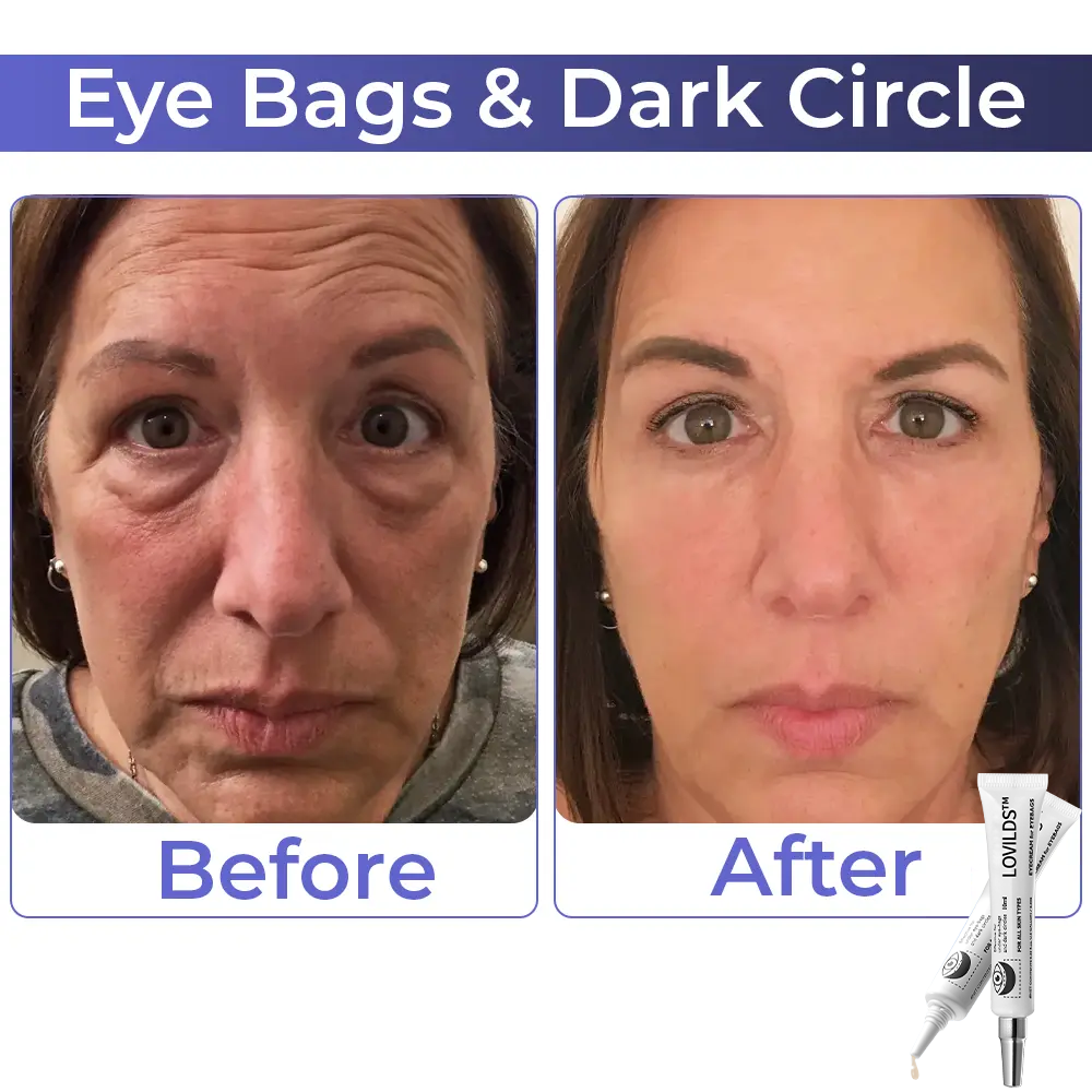 Buy 1 Get 1 Free  49%offđ„Eyebag Cream
