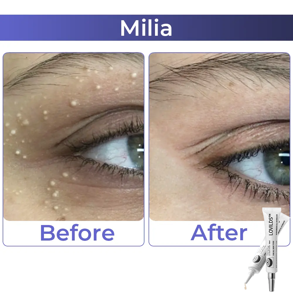 Buy 1 Get 1 Free  49%offđ„Eyebag Cream